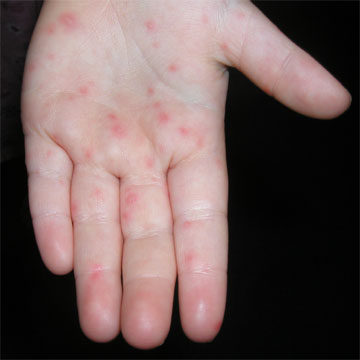 Hand-Foot-and-Mouth-Disease-Images.jpg