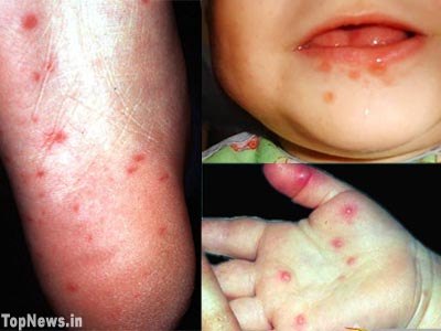 Hand-Foot-and-Mouth-Disease-Pictures.jpg