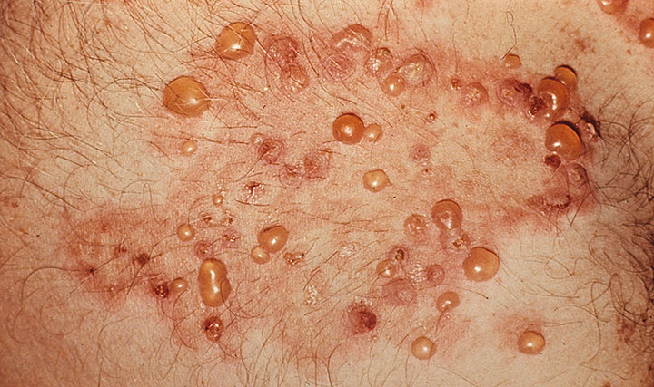 Dermatitis-Herpetiformis-Images.jpg