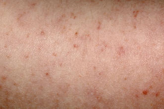 Most Common Skin Rashes In Adults