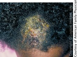 what to do for ringworm on scalp
