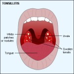 Swollen Tonsils - Symptoms, Causes, Pictures, Treatment and Home Remedies