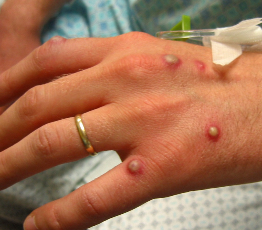 Vesicular Rash - Pictures, Definition, Diagnosis and Treatment