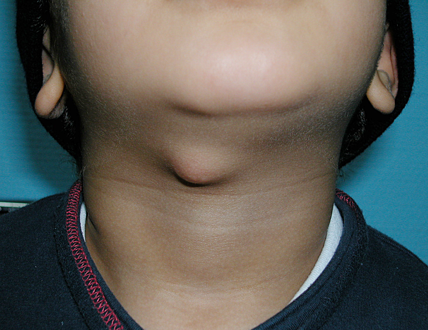 Thyroglossal Duct Cyst Pictures Symptoms Treatment And Surgery