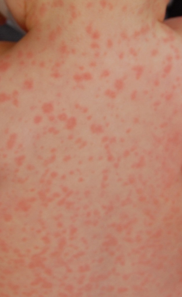 amoxicillin-rash-pictures-causes-symptoms-precautions-and-treatment