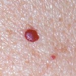 Cherry-Angioma-150x150.jpg