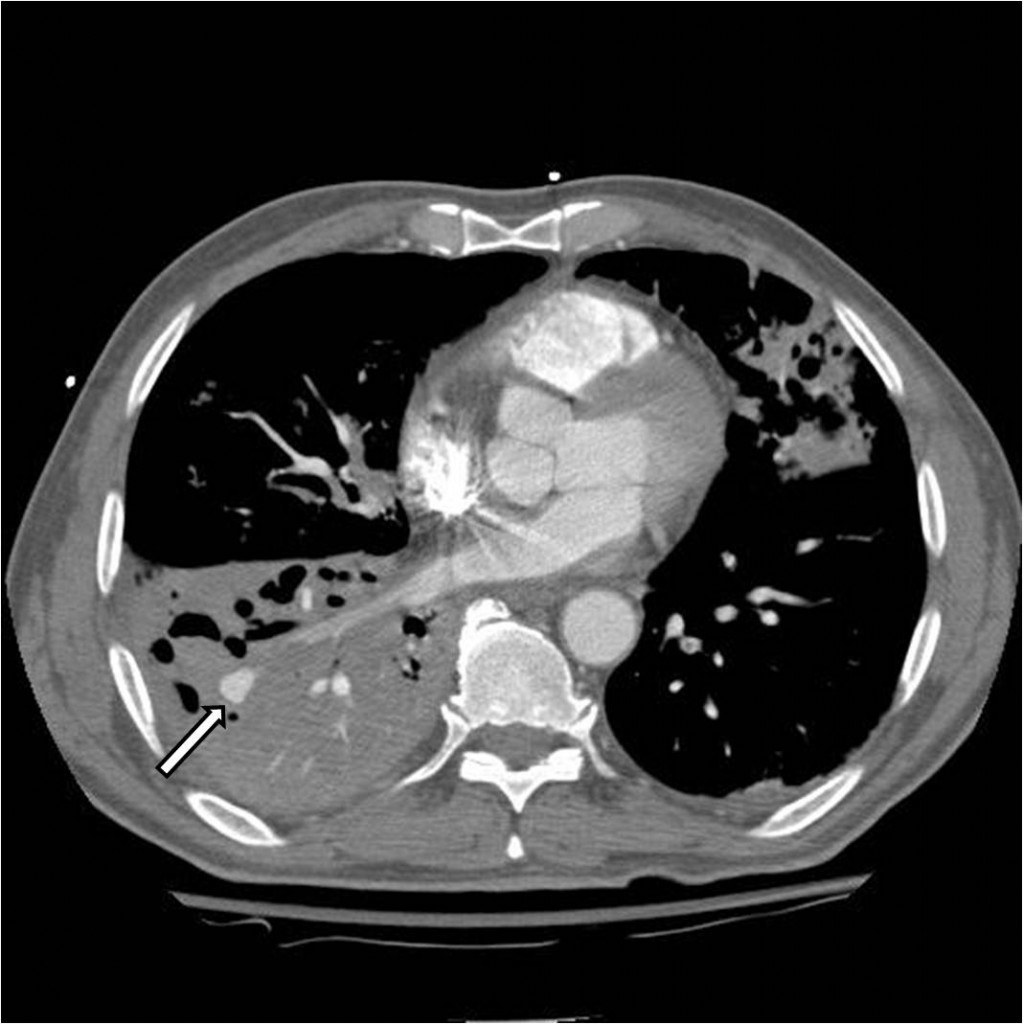 Hemoptysis