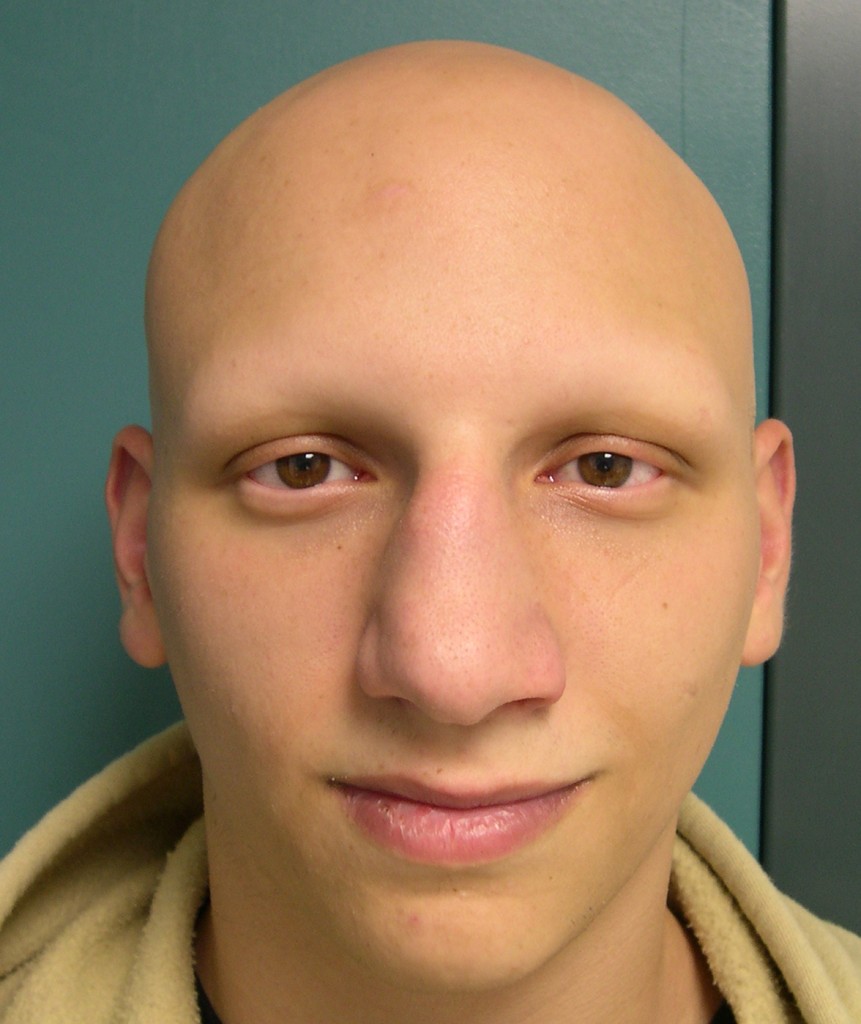 alopecia universalis regrowth