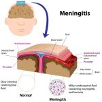 Cryptococcal meningitis | Causes, Signs and Symptoms, Treatment