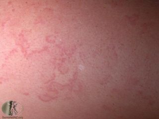 Erythema Marginatum | Pictures, Causes, Signs & symptoms, Treatment